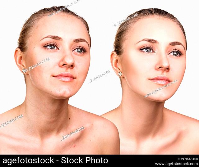 Woman with problem skin before and after treatment