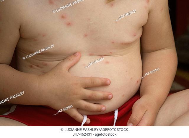 1 year old boys tummy covered in chicken pox