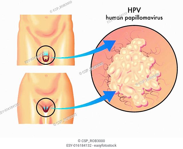 Analize Human Papilloma Virus (HPV)