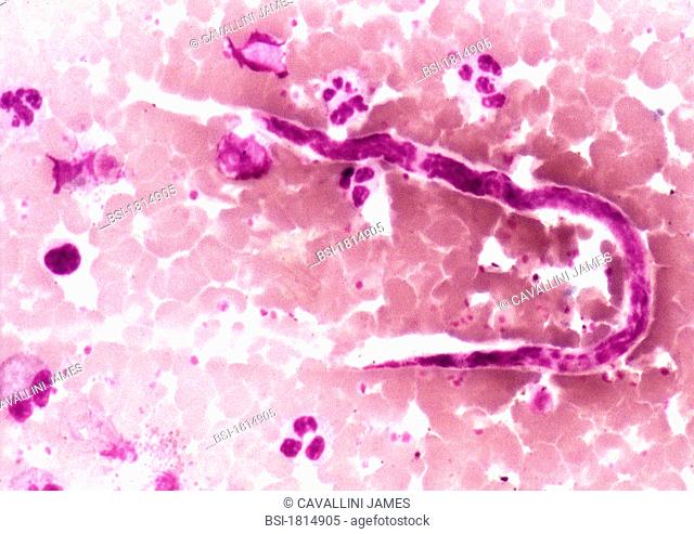 Filaria Onchocerca volvulus - the parasitic worm responsible for onchocerciasis tropical river blindness